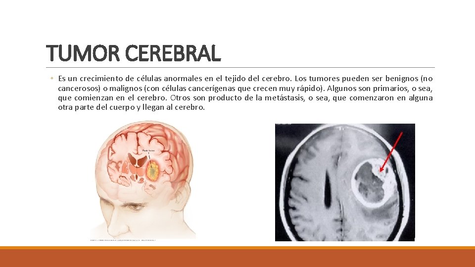 TUMOR CEREBRAL ◦ Es un crecimiento de células anormales en el tejido del cerebro.