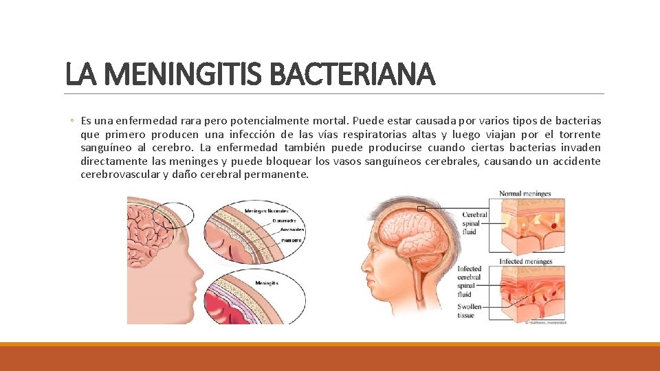 LA MENINGITIS BACTERIANA ◦ Es una enfermedad rara pero potencialmente mortal. Puede estar causada