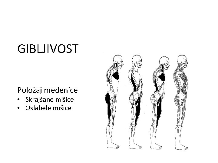 GIBLJIVOST Položaj medenice • Skrajšane mišice • Oslabele mišice 