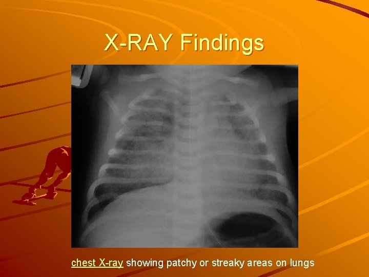 X-RAY Findings chest X-ray showing patchy or streaky areas on lungs 