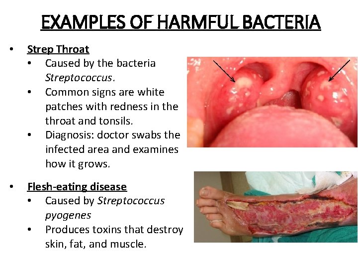 EXAMPLES OF HARMFUL BACTERIA • Strep Throat • Caused by the bacteria Streptococcus. •
