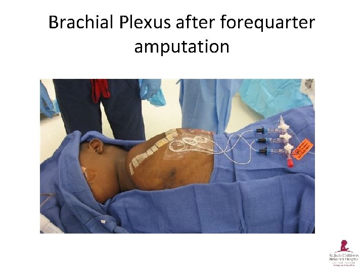 Brachial Plexus after forequarter amputation 
