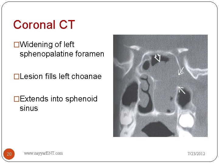Coronal CT �Widening of left sphenopalatine foramen �Lesion fills left choanae �Extends into sphenoid