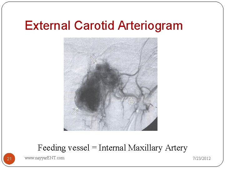 External Carotid Arteriogram Feeding vessel = Internal Maxillary Artery 21 www. nayyar. ENT. com