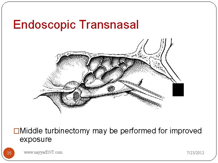 Endoscopic Transnasal �Middle turbinectomy may be performed for improved exposure 35 www. nayyar. ENT.