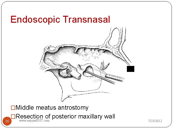 Endoscopic Transnasal �Middle meatus antrostomy 36 �Resection of posterior maxillary wall www. nayyar. ENT.