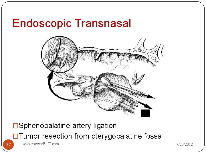 Endoscopic Transnasal �Sphenopalatine artery ligation �Tumor resection from pterygopalatine fossa 37 www. nayyar. ENT.