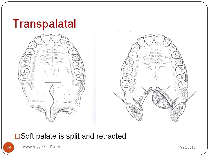 Transpalatal �Soft palate is split and retracted 39 www. nayyar. ENT. com 7/23/2012 