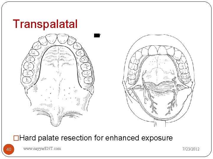 Transpalatal �Hard palate resection for enhanced exposure 40 www. nayyar. ENT. com 7/23/2012 