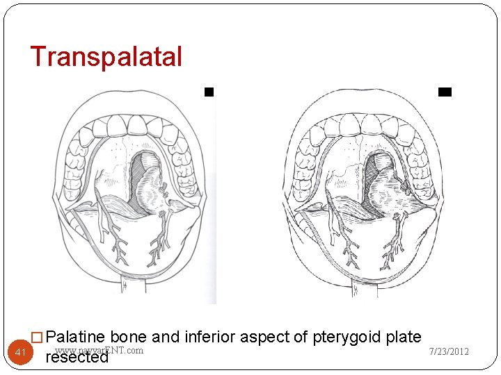 Transpalatal � Palatine bone and inferior aspect of pterygoid plate 41 www. nayyar. ENT.