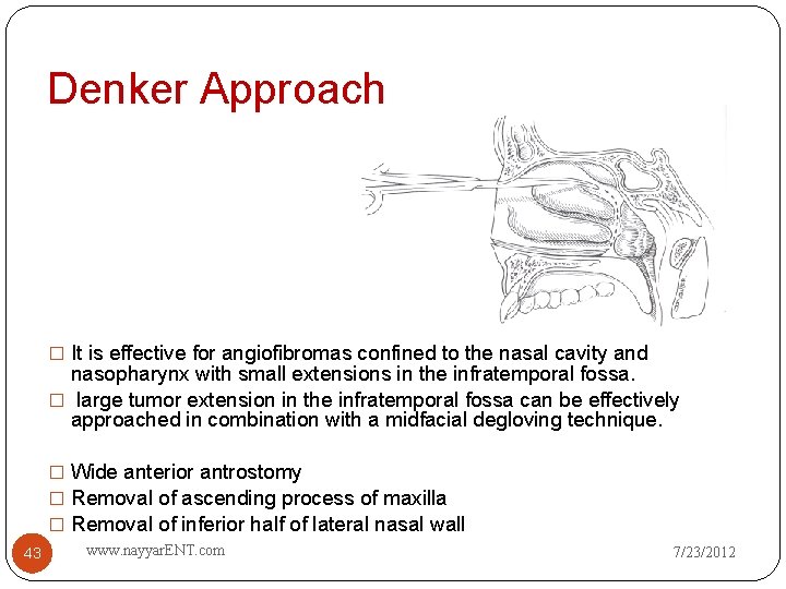 Denker Approach � It is effective for angiofibromas confined to the nasal cavity and