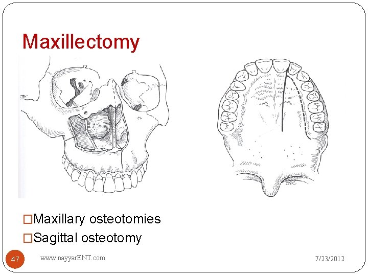 Maxillectomy �Maxillary osteotomies �Sagittal osteotomy 47 www. nayyar. ENT. com 7/23/2012 
