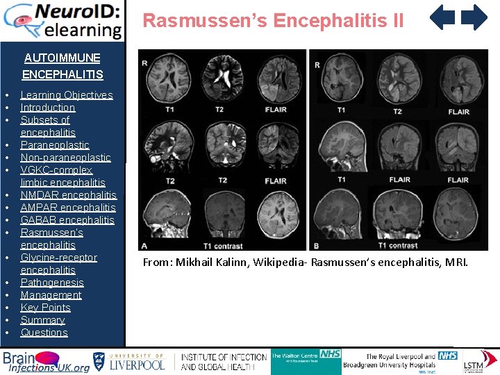 Rasmussen’s Encephalitis II AUTOIMMUNE ENCEPHALITIS • • • • Learning Objectives Introduction Subsets of