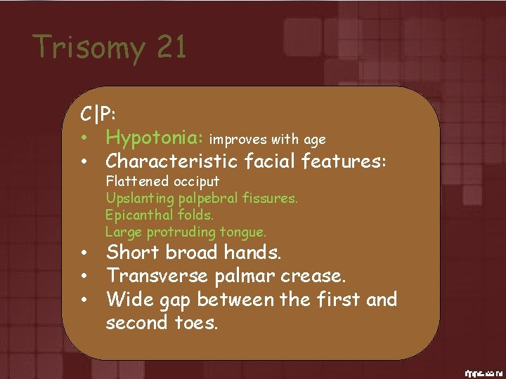 Trisomy 21 C|P: • Hypotonia: improves with age • Characteristic facial features: Flattened occiput