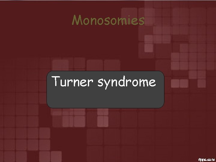 Monosomies Turner syndrome 