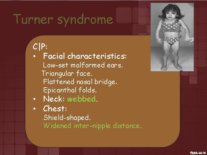 Turner syndrome C|P: • Facial characteristics: Low-set malformed ears. Triangular face. Flattened nasal bridge.