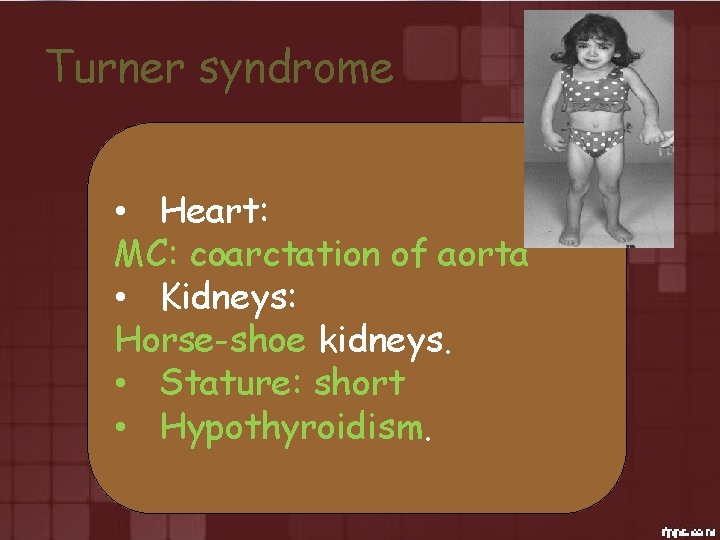Turner syndrome • Heart: MC: coarctation of aorta • Kidneys: Horse-shoe kidneys. • Stature: