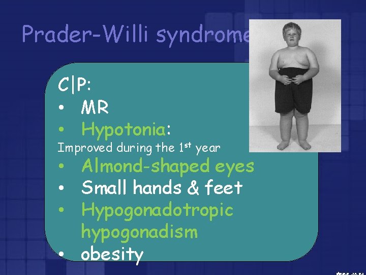 Prader-Willi syndrome C|P: • MR • Hypotonia: Improved during the 1 st year •