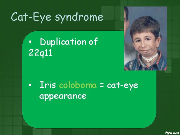 Cat-Eye syndrome • Duplication of 22 q 11 • Iris coloboma = cat-eye appearance