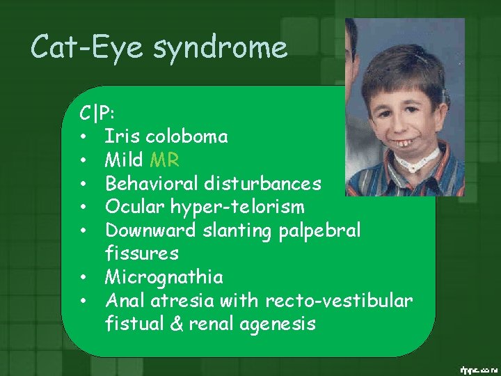 Cat-Eye syndrome C|P: • Iris coloboma • Mild MR • Behavioral disturbances • Ocular