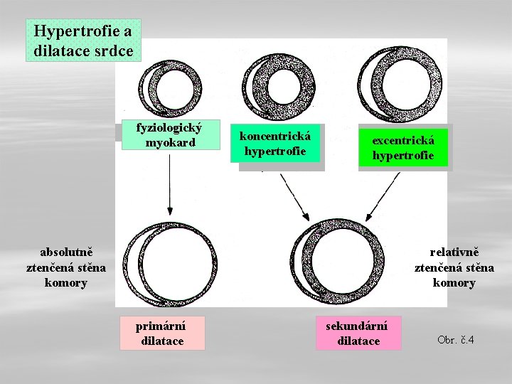 Hypertrofie a dilatace srdce fyziologický myokard koncentrická hypertrofie excentrická hypertrofie absolutně ztenčená stěna komory