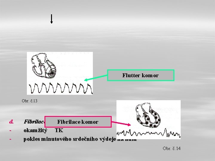 Flutter komor Obr. č. 13 d. - Fibrilace a flutter komor Fibrilace komor okamžitý