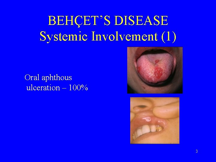 BEHÇET’S DISEASE Systemic Involvement (1) Oral aphthous ulceration – 100% 3 