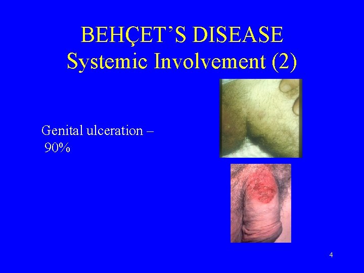 BEHÇET’S DISEASE Systemic Involvement (2) Genital ulceration – 90% 4 