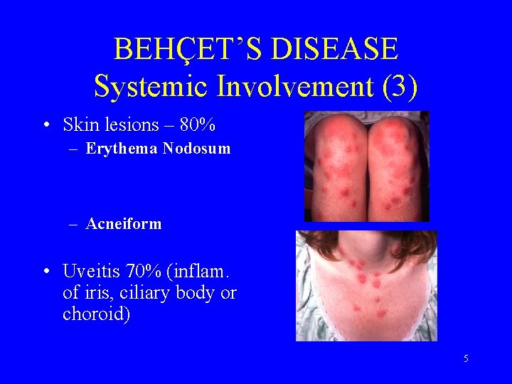 BEHÇET’S DISEASE Systemic Involvement (3) • Skin lesions – 80% – Erythema Nodosum –