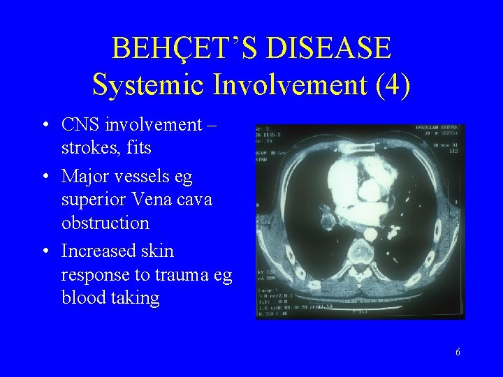 BEHÇET’S DISEASE Systemic Involvement (4) • CNS involvement – strokes, fits • Major vessels