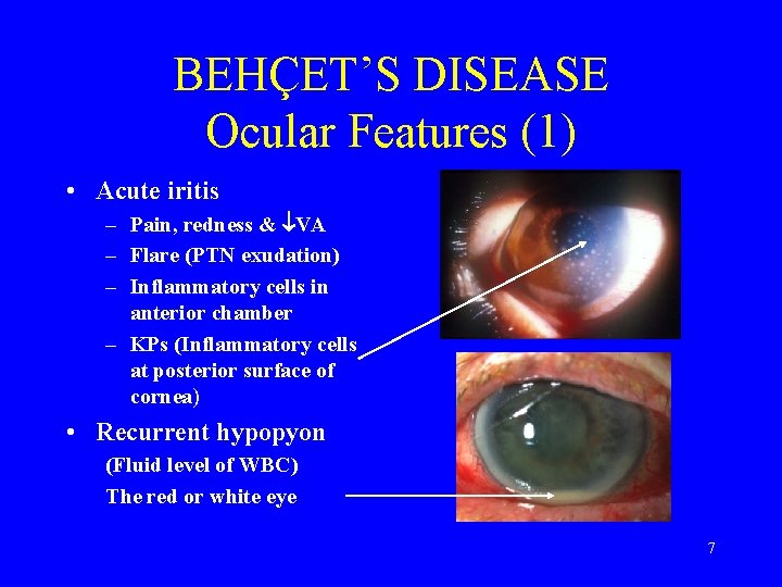 BEHÇET’S DISEASE Ocular Features (1) • Acute iritis – Pain, redness & VA –