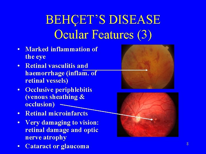 BEHÇET’S DISEASE Ocular Features (3) • Marked inflammation of the eye • Retinal vasculitis