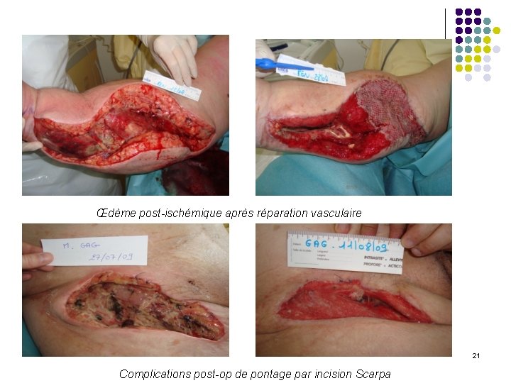 Œdème post-ischémique après réparation vasculaire 21 Complications post-op de pontage par incision Scarpa 