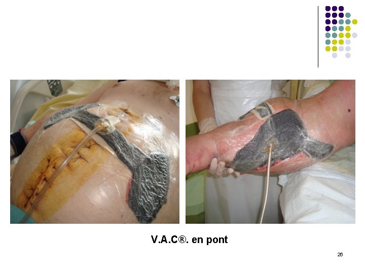 V. A. C®. en pont 26 