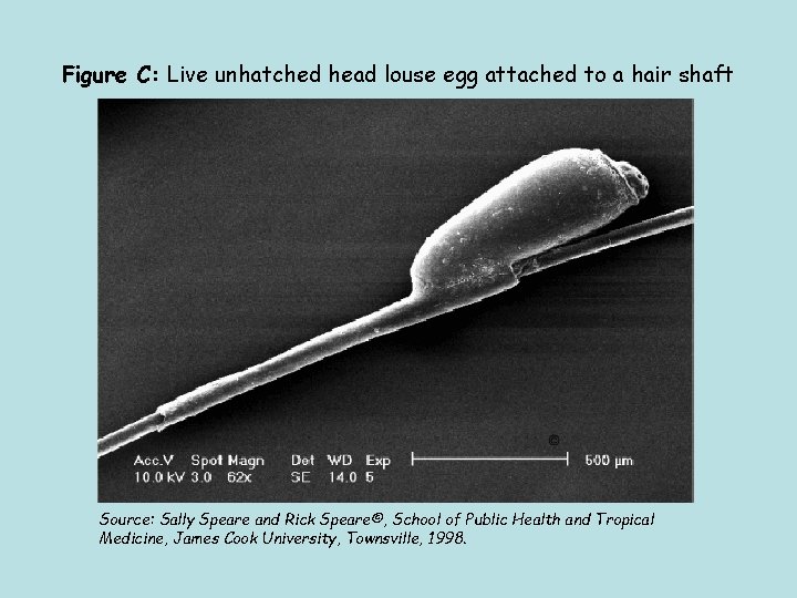 Figure C: Live unhatched head louse egg attached to a hair shaft Source: Sally