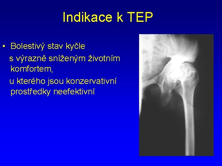 Indikace k TEP • Bolestivý stav kyčle s výrazně sníženým životním komfortem, u kterého