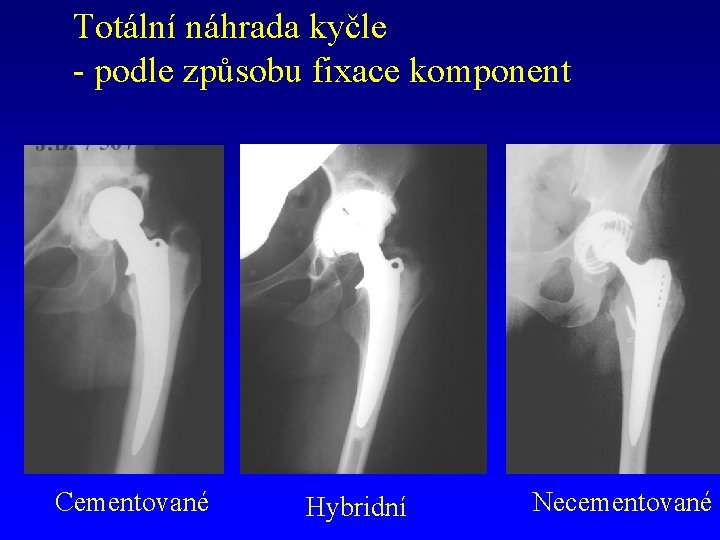 Totální náhrada kyčle - podle způsobu fixace komponent Cementované Hybridní Necementované 