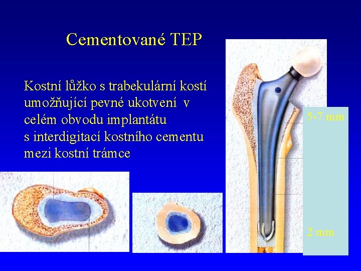 Cementované TEP Kostní lůžko s trabekulární kostí umožňující pevné ukotvení v celém obvodu implantátu