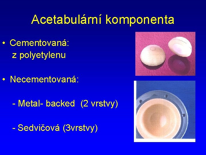 Acetabulární komponenta • Cementovaná: z polyetylenu • Necementovaná: - Metal- backed (2 vrstvy) -