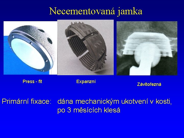 Necementovaná jamka Press - fit Expanzní Závitořezná Primární fixace: dána mechanickým ukotvení v kosti,