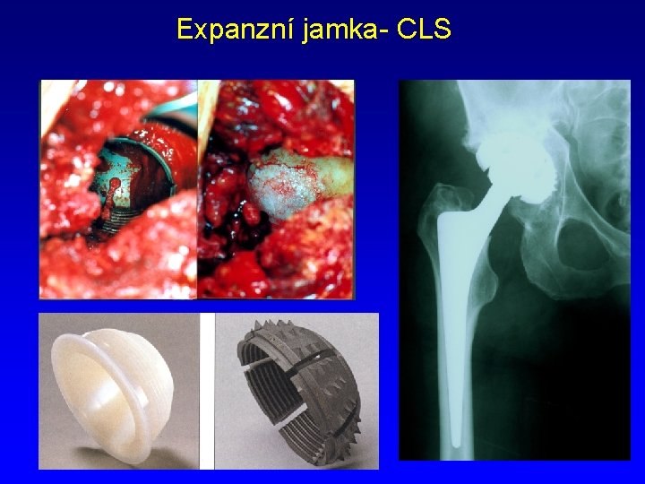 Expanzní jamka- CLS 