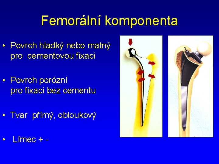 Femorální komponenta • Povrch hladký nebo matný pro cementovou fixaci • Povrch porózní pro