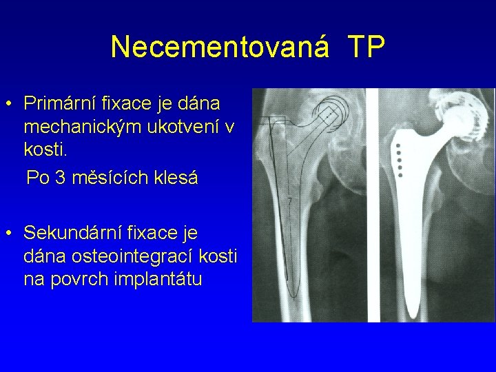 Necementovaná TP • Primární fixace je dána mechanickým ukotvení v kosti. Po 3 měsících