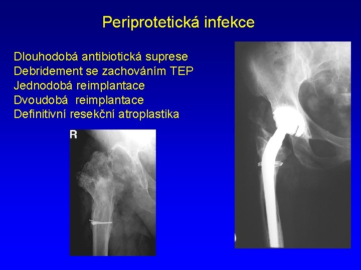 Periprotetická infekce Dlouhodobá antibiotická suprese Debridement se zachováním TEP Jednodobá reimplantace Dvoudobá reimplantace Definitivní