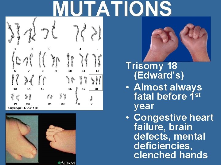 MUTATIONS Trisomy 18 (Edward’s) • Almost always fatal before 1 st year • Congestive