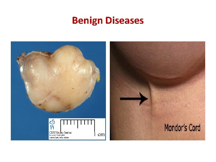 Benign Diseases 