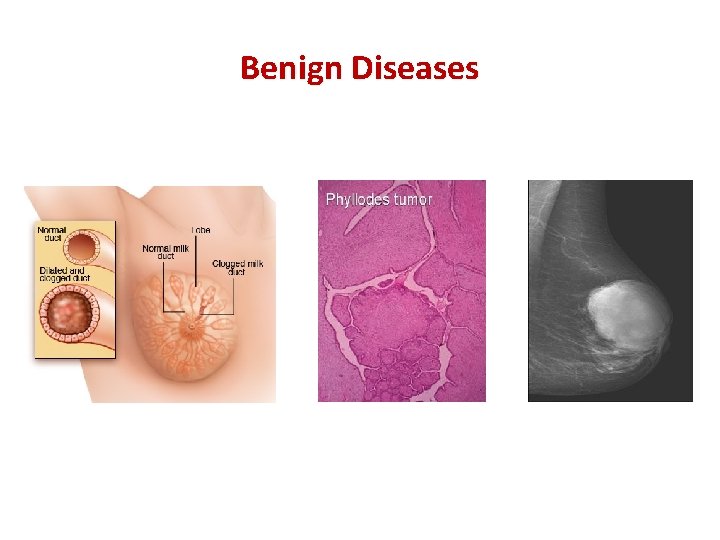 Benign Diseases 
