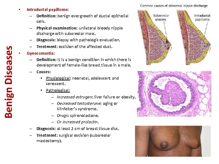 Benign Diseases • • Intraductal papilloma: – Definition: benign overgrowth of ductal epithelial cells.