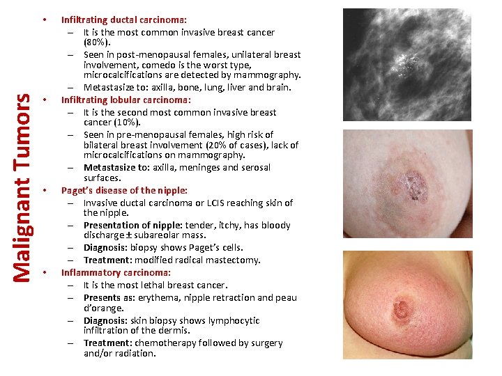 Malignant Tumors • • Infiltrating ductal carcinoma: – It is the most common invasive