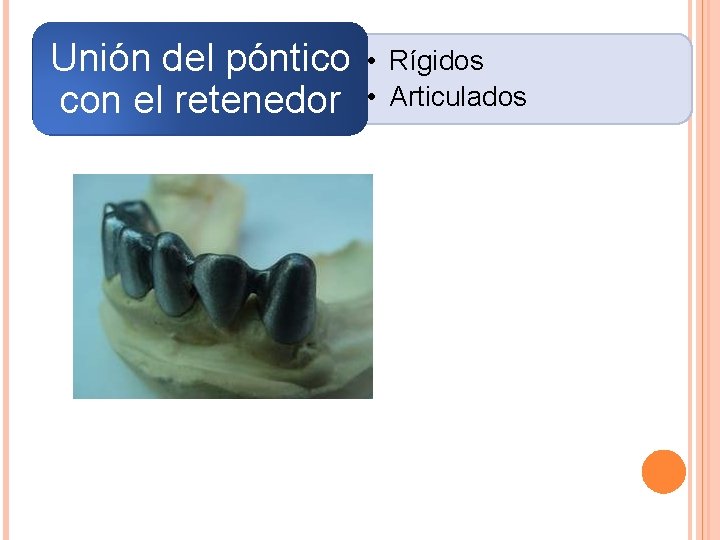 Unión del póntico con el retenedor • Rígidos • Articulados 